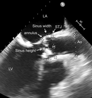 Figure 22.2, Aortic stenosis with 2D valve measurement in the LVOT view. LV, left ventricle; LA, left atrium; Ao, ascending aorta; Sinus, sinus of Valsalva; STJ, sinutubular junction.