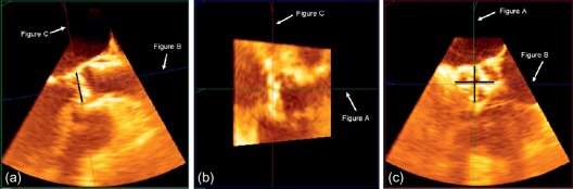 Figure 22.3, Aortic stenosis with 3D aortic annular measurement by means of multiplanar reconstruction. (a) Aortic valve in the sagittal LVOT view where the 3D volume is acquired. Black bar: 2D measurement of aortic annulus. (b) Aortic valve in a transversal view corresponding to the horizontal plane in A. (c) Aortic valve in a coronal view corresponding to the vertical planes in A and B. The vertical plane in A can be moved to the annular level of the aortic valve so that the maximum annular diameter can be measured in the coronal view in addition to the direct measurement in A. Furthermore, the coronal view enables direct planimetry of the aortic annulus area. Black bars: aortic annular measurement.