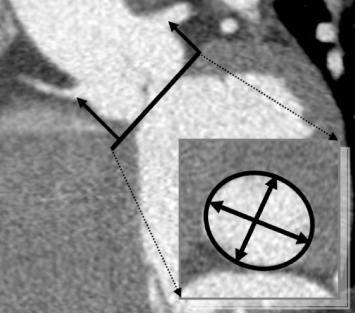 Figure 22.4, Required measurements in the aortic valve annulus plane, which represents a double-oblique plane, including all three lowest insertion points of the aortic valve leaflets. Furthermore, the distances between the aortic annulus plane and the coronary artery ostia are derived.