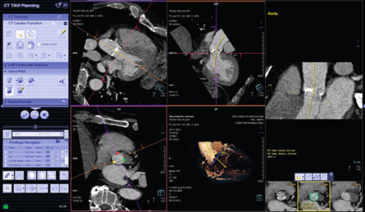 Figure 22.5, Example of a dedicated CT software package for the automated segmentation and analysis of aortic valves.