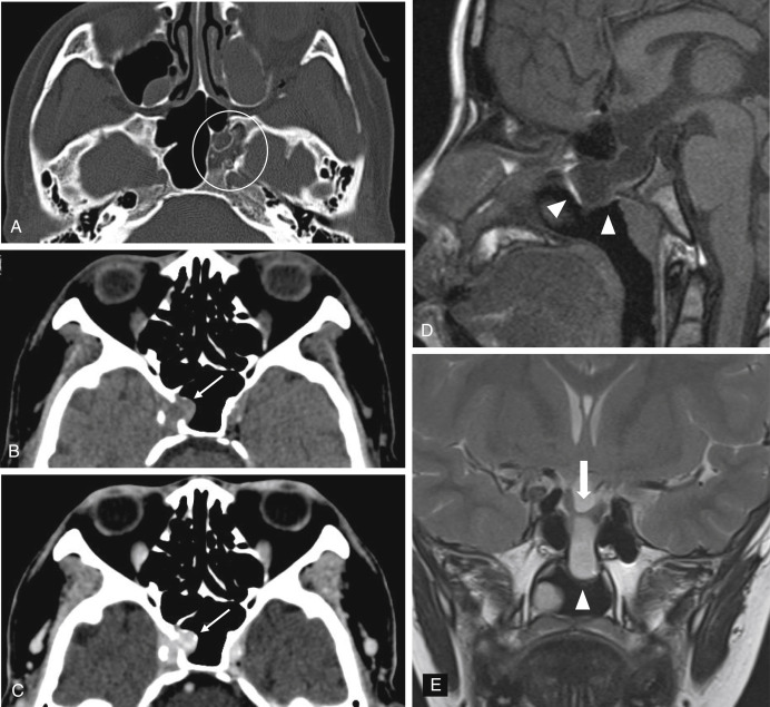 Fig. 4.1, Examples of “do not touch” lesions: Axial CT image (A) shows the typical appearance of arrested pneumatization, a nonexpansile lesion with internal curvilinear calcifications, sclerotic margins, and fat density ( circled ). Internal carotid artery pseudoaneurysm (B and C) : Axial non-contrast- and contrast-enhanced CT images show a bony defect in the sphenoid sinus wall, with contiguous, enhancing soft tissue protruding through the defect. Note the subtle rim calcification, which should alert the radiologist to the diagnosis ( thin arrows ). In this case, the pseudoaneurysm was related to invasive fungal infection. Sagittal T1-weighted (D) and coronal T2-weighted (E) images show a transsellar, transsphenoidal encephalocele ( arrowheads in D and E ) at the location of the craniopharyngeal canal. There is slight prolapse of the optic chiasm inferiorly ( thick arrow in E ).