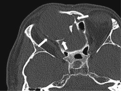 Fig. 4.2, Bony remodeling and expansion. Axial CT (bone algorithm) shows bony remodeling and expansion ( arrows ) in this right frontal mucocele. These are features of a relatively indolent, slowly expansile lesion. Such a process is unlikely to have breached the periorbita despite significant orbital compression.