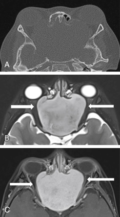 Fig. 4.3, Intact periorbita (A) . Axial CT shows dehiscence of the lamina papyracea. Axial fat-suppressed T2-weighted ( arrows in B ) and postgadolinium T1-weighted ( arrows in C ) images. The low signal of the periorbita is clearly intact, indicating the periorbita has not been breached.