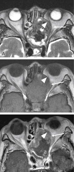 Fig. 4.4, Invasion of the periorbita by squamous cell carcinoma. Axial T2-weighted (A) , T1-weighted (T1W) (B) , and postgadolinium T1W (C) images. The periorbita is partially indistinct ( thin arrows ), indicating invasion. The intact portion of the periorbita remains clearly visible ( arrowheads ).