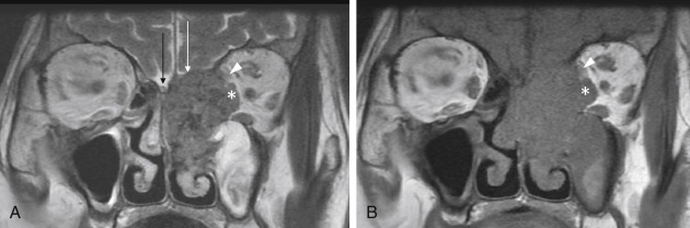 Fig. 4.5, Invasion of the periorbita by squamous cell carcinoma (A and B) . Coronal T2-weighted and T1-weighted images show infiltration and loss of fat plane between the tumor and the medial rectus ( asterisk ) and superior oblique muscle bellies ( arrowheads ). Note that there is also intradural extension ( thin white arrow in A ). The left olfactory nerve is engulfed by tumor, whereas the right olfactory nerve ( thin black arrow in A ) is normal.