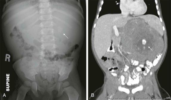 Figure 66-1, Neuroblastoma, detected incidentally.