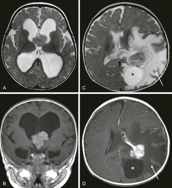 Figure 66-12, Choroid plexus papilloma.