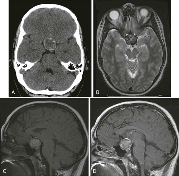 Figure 66-13, Craniopharyngioma.