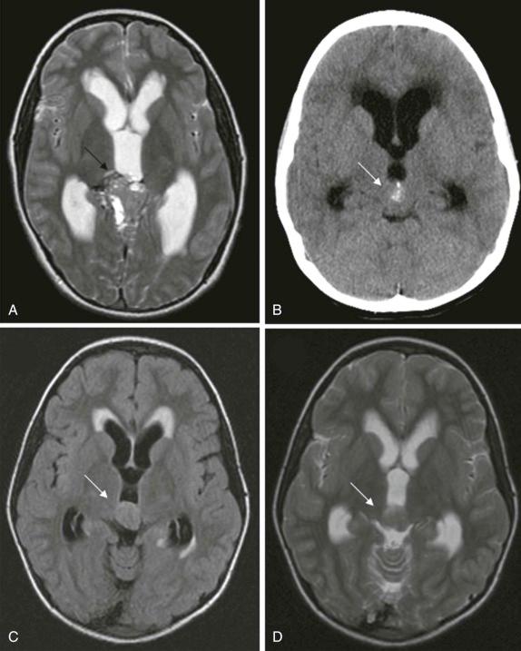 Figure 66-14, Pinealoblastoma.