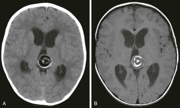 Figure 66-15, Pineal germ-cell tumor.