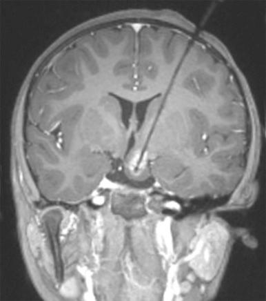 Figure 66-17, MRI-guided laser ablation of hypothalamic hamartoma in a 4-year-old female with medically intractable gelastic seizures.