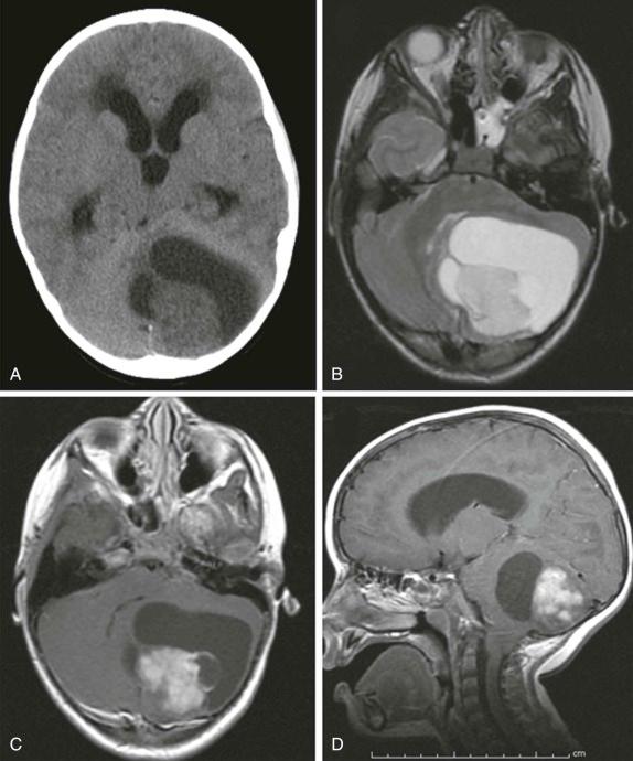 Figure 66-19, Cerebellar pilocytic astrocytoma.