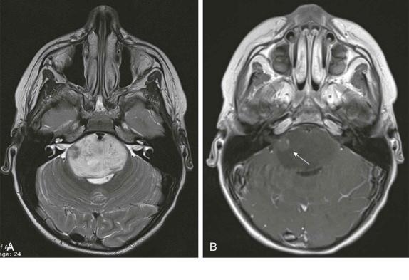 Figure 66-20, Low-grade pontine glioma.