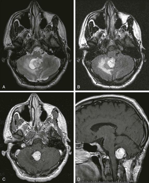 Figure 66-22, Hemangioblastoma.