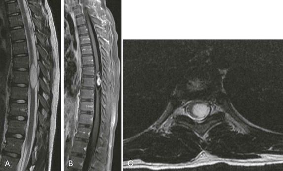 Figure 66-23, Spinal cord astrocytoma.