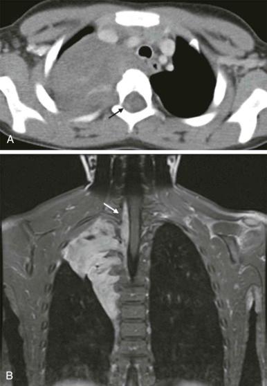 Figure 66-25, Upper thoracic paraspinal neuroblastoma.