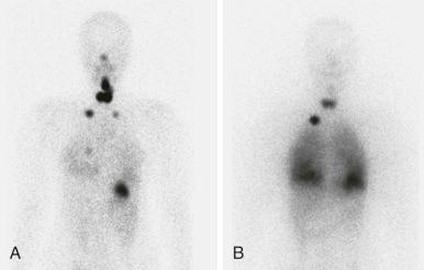 Figure 66-27, An 18-year-old patient with a history of stage-2 Hodgkin lymphoma treated with chemotherapy and radiation who developed a palpable thyroid nodule that was found to be papillary thyroid carcinoma.