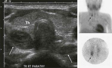 Figure 66-28, Parathyroid adenoma.