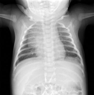 Figure 66-29, Anteroposterior chest radiograph of an infant shows prominent thymic shadow and undulating contour conforming to the adjacent ribs, findings all consistent with normal thymic tissue.
