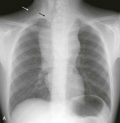 Figure 66-30, A , Chest x-ray showing marked tracheal deviation, pneumomediastinum, and subcutaneous emphysema along the right neck in a child with lymphoblastic lymphoma, emphasizing the severity of airway obstruction and potential for respiratory compromise (arrows) . B - E , CT shows large anterior mediastinal mass with mediastinal air around the heart, pulmonary vessels, aorta, and esophagus ( C ). The trachea is markedly narrowed (arrow), likely the cause of the pneumomediastinum. Subcutaneous air is also evident in the anterior chest wall. Five days later the findings had progressed considerably ( C and D ).