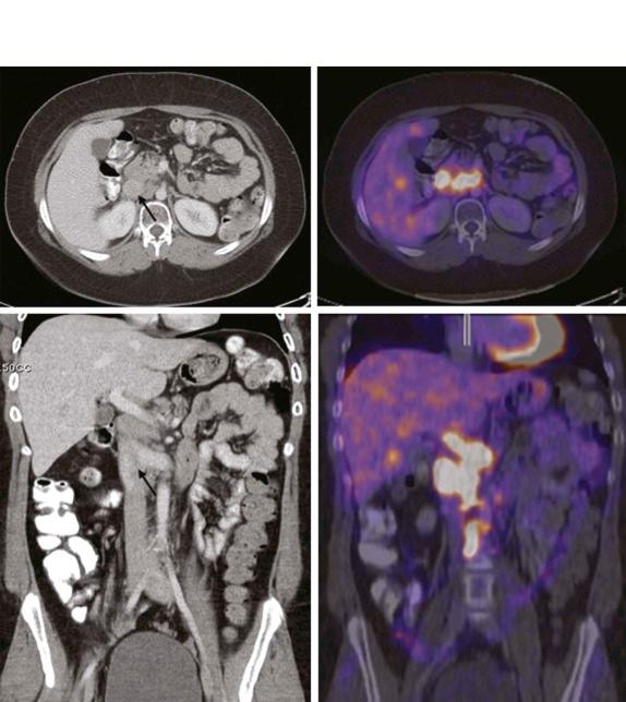 Figure 66-31, FDG-PET and image fusion delineate equivocal areas of abnormality on CT (arrows), identifying foci of disease recurrence in a patient with Hodgkin lymphoma.