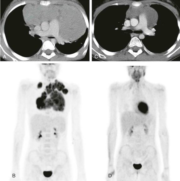 Figure 66-32, Hodgkin Lymphoma