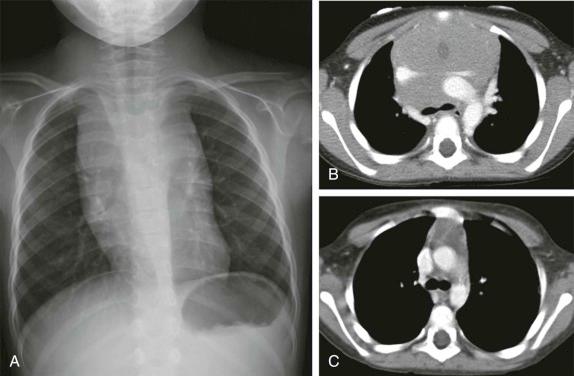 Figure 66-33, A 4-year-old child with T-cell ALL and a large mediastinal mass with airway and vascular compression seen by CXR (A) and CT (B) , showing near complete resolution of the mass after just 2 weeks of therapy (C) .