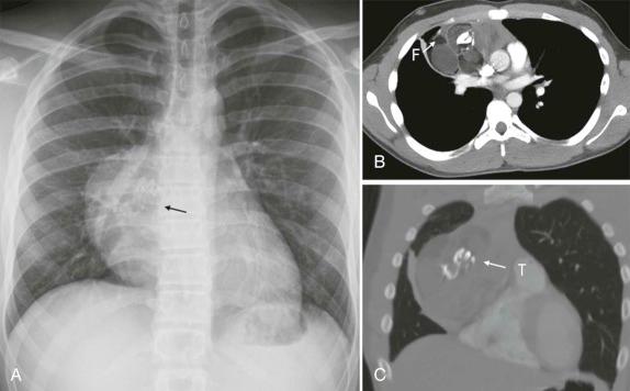 Figure 66-34, A 15-year-old boy with mediastinal mass seen incidentally on a chest x-ray obtained for pain after a football injury (A) . Subsequent CT ( B and C ) shows fat (F) and adjacent solid elements in addition to calcification, in this case taking the form of tooth (T), characteristic of germ cell tumor, in this case mature teratoma.