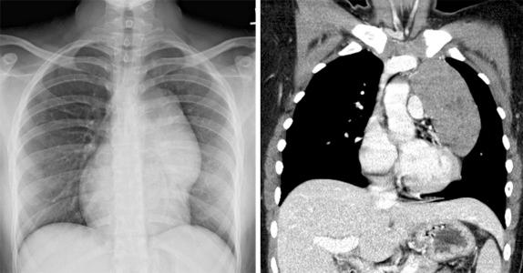 Figure 66-35, A 15-year-old girl with a 2-week history of chest pain.
