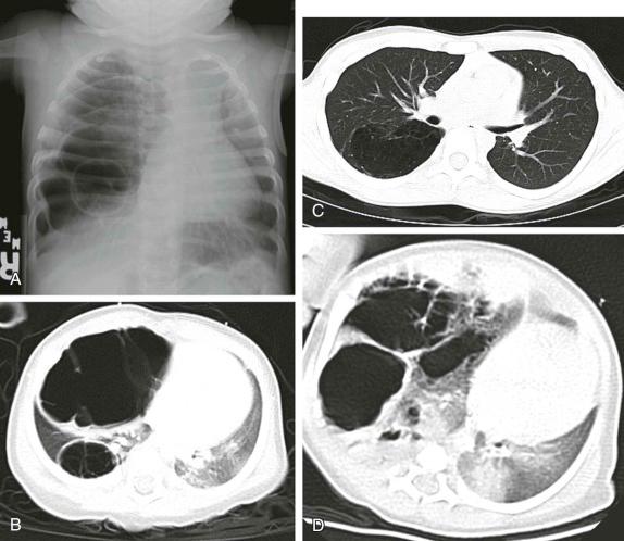 Figure 66-37, Pleuropulmonary blastoma ( A and B ). Note the difficulty in distinguishing this malignancy from C-CAM ( C and D ).