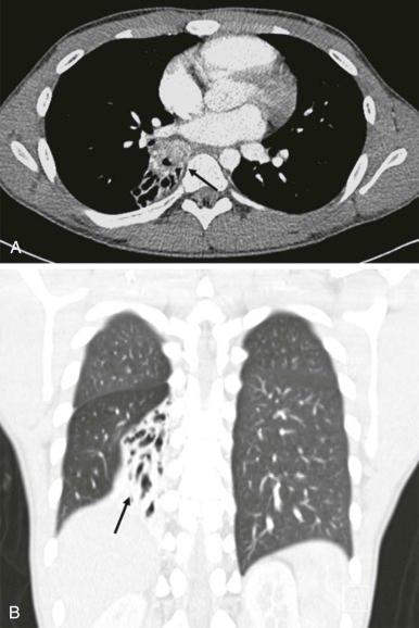Figure 66-38, A and B , Bronchial carcinoid tumor with CT showing a hypervascular enhancing endobronchial mass ( A , arrow ), causing postobstructive collapse of the right lower lobe ( B , arrow ). 111 In-octreotide scintigraphy ( C ) and FDG-PET ( D ) both show accumulation in the mass and were helpful in staging this patient's tumor.