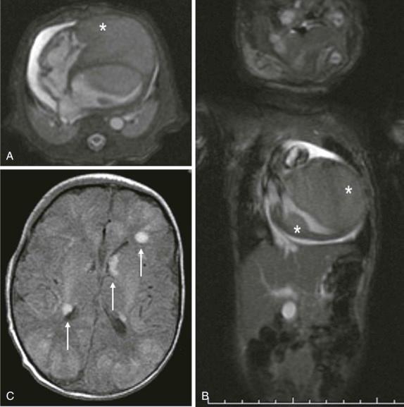 Figure 66-40, Cardiac rhabdomyoma.