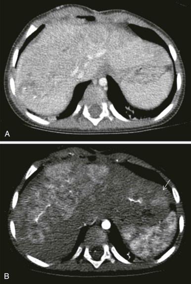 Figure 66-4, A 20-month-old child with unresectable hepatoblastoma, emphasizing the importance of multiphase scanning for optimal lesion detection.