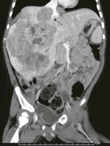 Figure 66-41, Coronal contrast-enhanced CT showing direct extension into the IVC in a 15-month-old patient with hepatoblastoma.