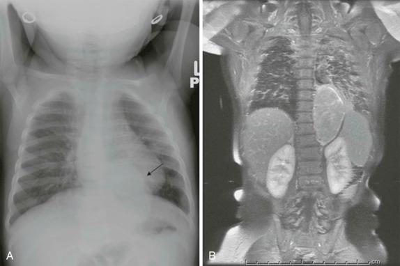 Figure 66-42, Posterior mediastinal neuroblastoma in a 5-month-old infant who showed symptoms of an upper respiratory infection.