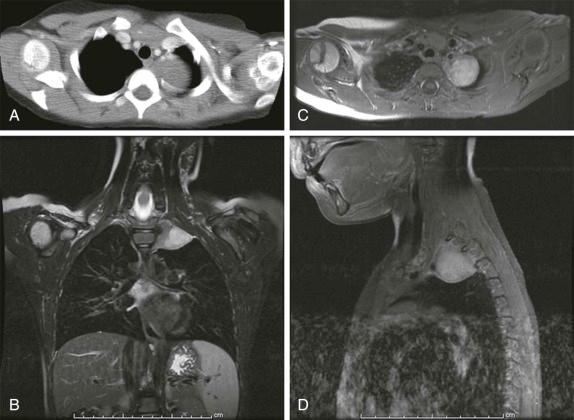 Figure 66-43, A 7-year-old child with a cough.