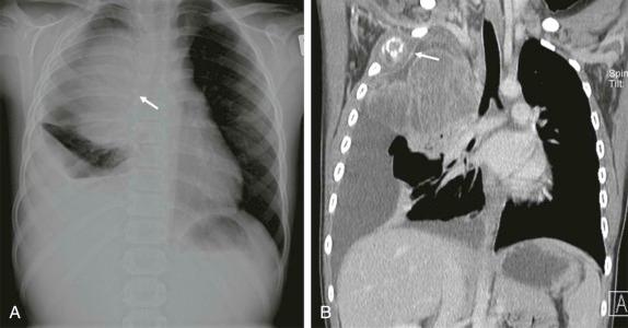 Figure 66-44, Ewing sarcoma of the chest wall in a 6-year-old patient with fever and a chest-wall mass detected by chest x-ray.