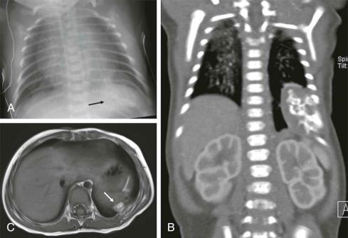 Figure 66-45, A 20-day-old infant with a prenatally diagnosed, calcified, left lower lung mass.