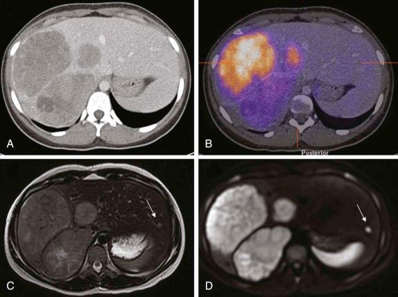 Figure 66-5, A 17-year-old adolescent with adrenocortical carcinoma primarily involving the right lobe.