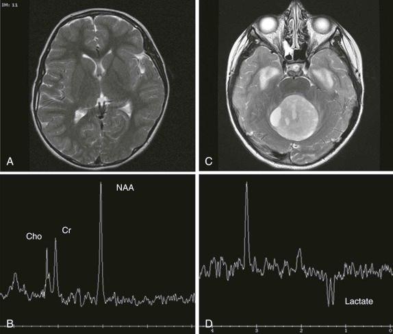 Figure 66-6, MRI and MR spectroscopy in a patient with medulloblastoma ( C and D ) compared with the normal MRI and spectrum on the left ( A and B ), demonstrating the increased Cho peak, decreased/absent NAA peak, and lactate peak characteristically seen in malignant lesions. Cho, Choline; Cr, creatine; NAA, N-acetylaspartate.