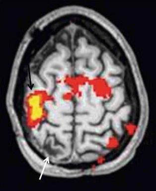 Figure 66-8, Functional MRI (fMRI) in an 18-year-old patient with a history of right posterior parietal oligoastrocytoma resection (white arrow), now showing epilepsy localized to around the surgical cavity. fMRI activation using left-finger tapping shows robust, right-lateralized activation of the primary motor cortex (black arrow) and subtle activation of midline supplementary motor cortex.