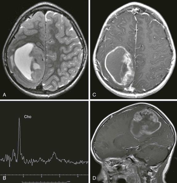 Figure 66-9, A 4-year-old patient with hemispheric astrocytoma.