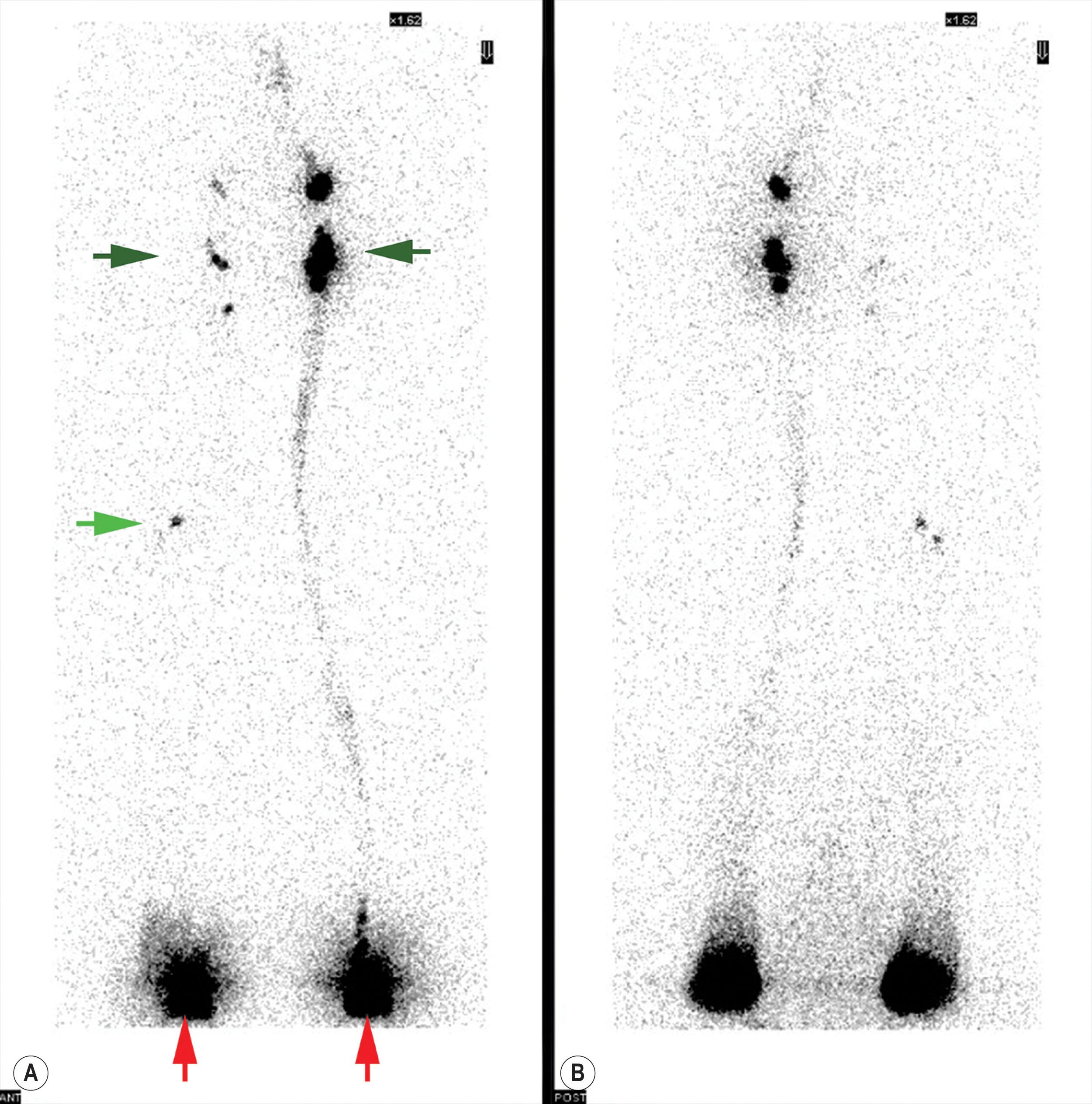 Figure 3.2.1, Anteroposterior transmission scintigraphy scan with a large field-of-view detector of the lower extremities after isotope administration and 20 minutes of walking. (A) Shows an anterior view; red arrows indicate the injection sites. Isotope uptake is depicted in popliteal (light green arrow) and inguinal (deep green arrows) lymph nodes. A reduced tracer accumulation can be observed on the affected right side. (B) Posterior view.