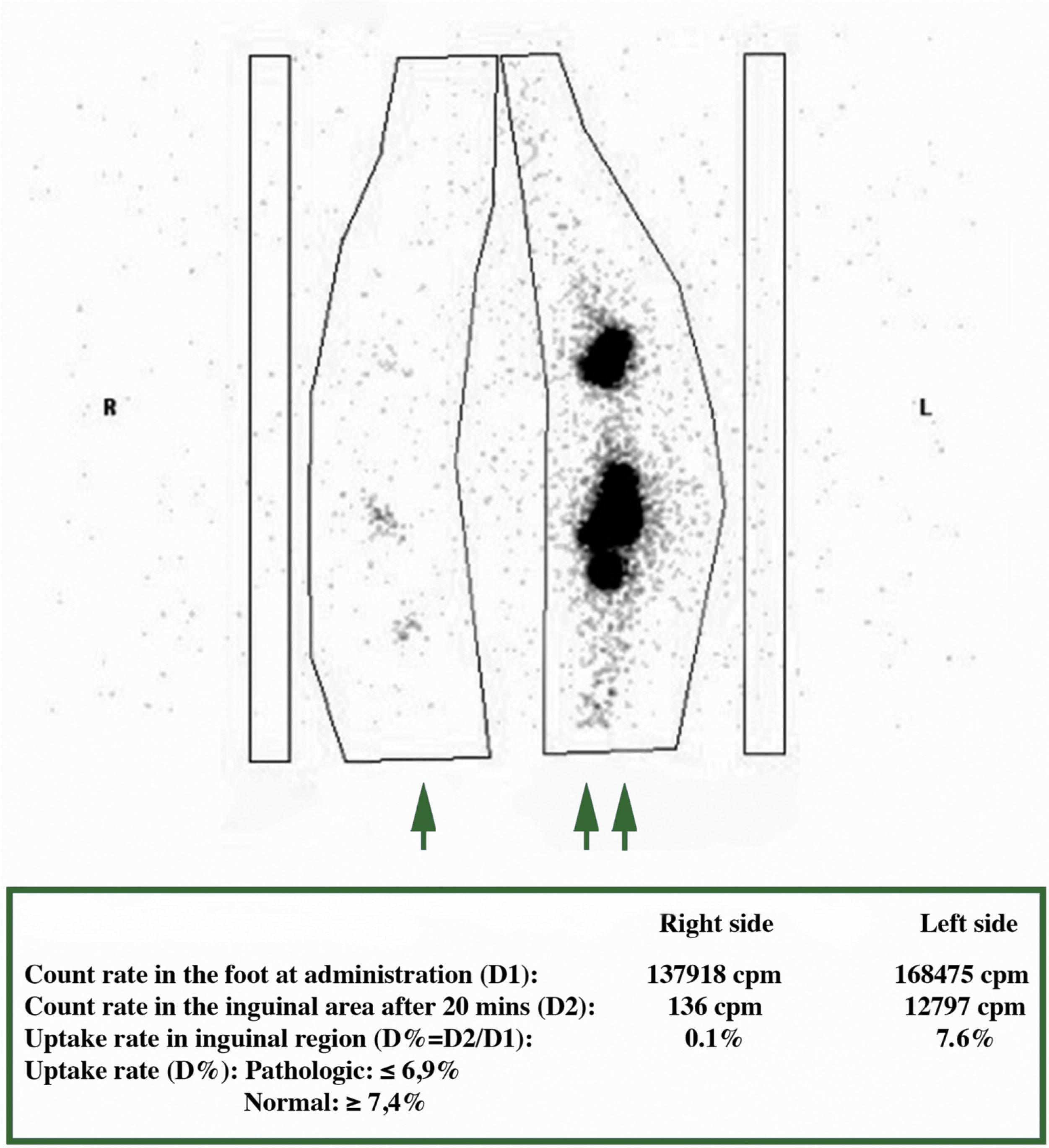 Figure 3.2.2, Quantitative evaluation based on the lymphoscintigraphy scan. (Inguinal area after isotope administration and 20 minutes of walking.) Isotope uptake rate in the inguinal lymph nodes is calculated on the healthy (double arrow) and affected (single arrow) sides. cpm, counts per minute.