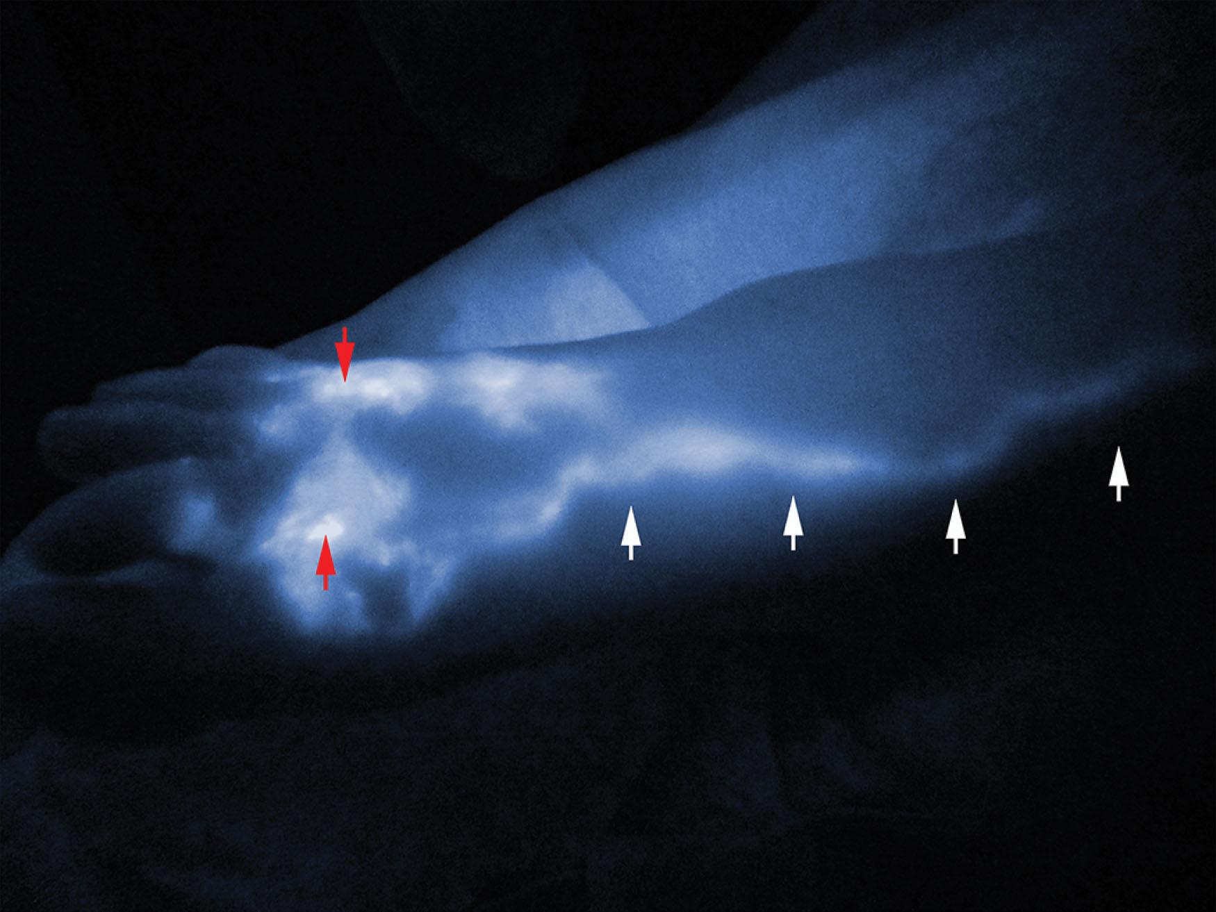 Figure 3.2.3, IGC lymphography demonstrates a functional lymph vessel as a linear pattern (white arrows) draining the injection sites (red arrows).