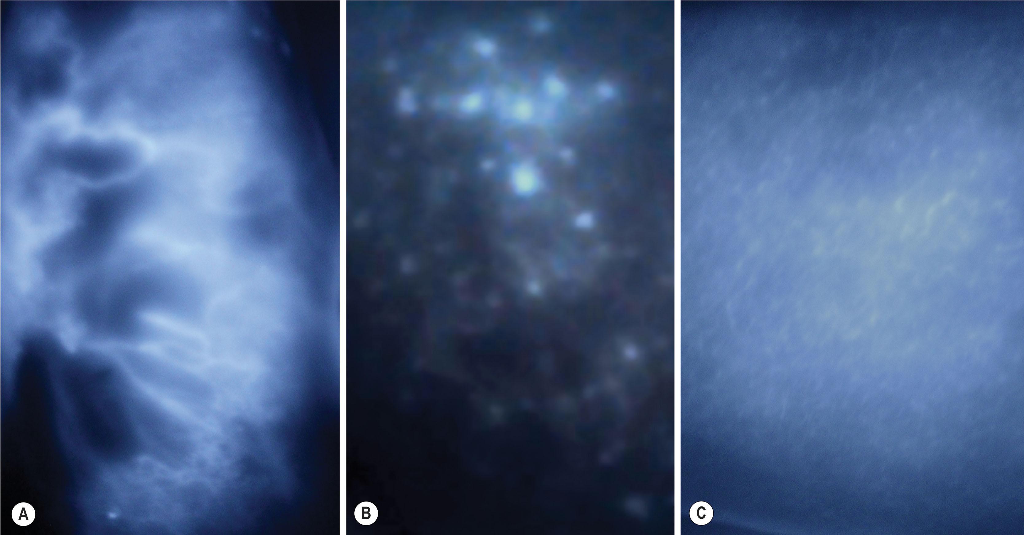 Figure 3.2.5, Shows ICG lymphography patterns in the late phase: (A) splash; (B) stardust; (C) diffuse.