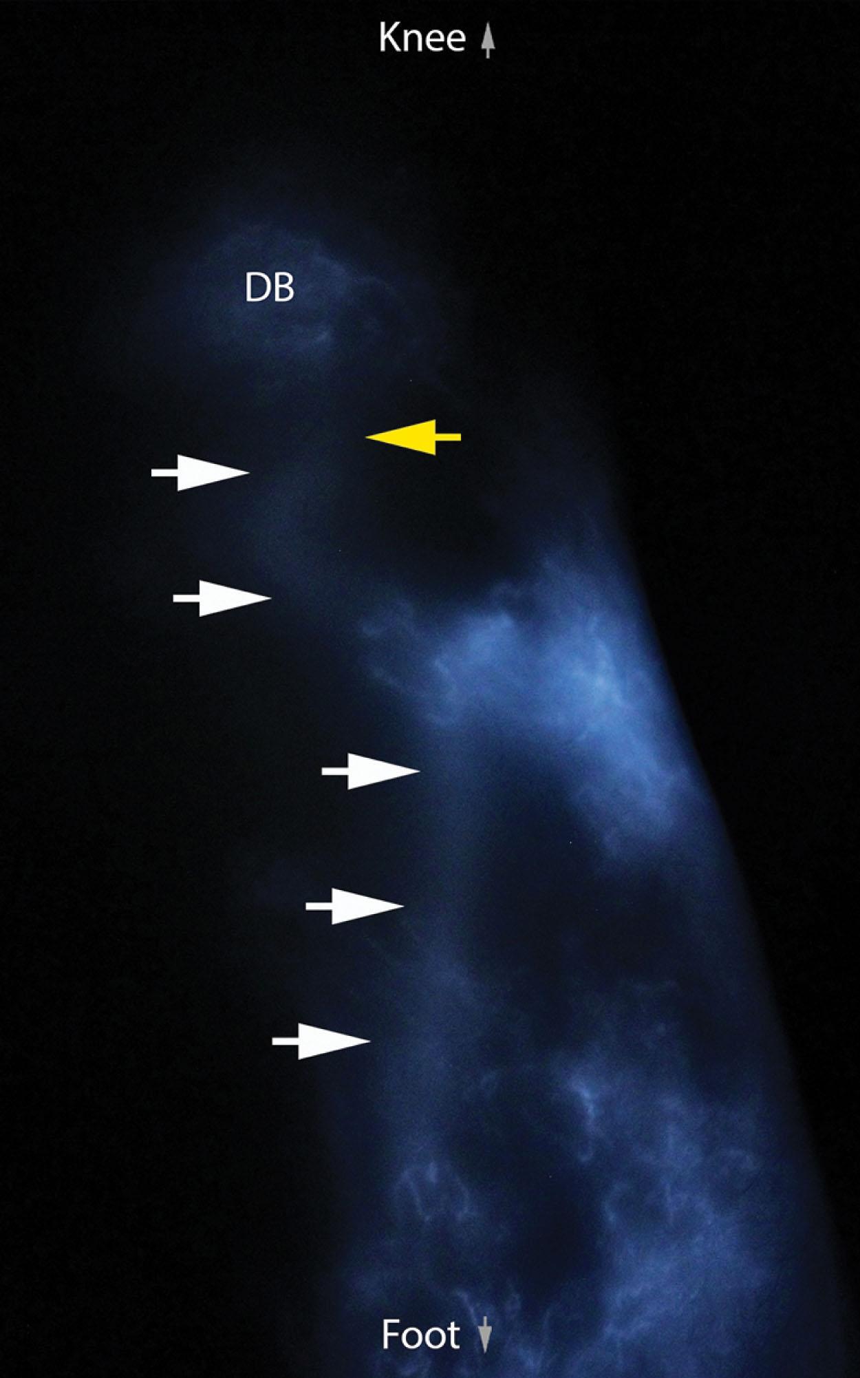 Figure 3.2.7, IGC lymphography indicates the optimal spot for LVA reconstruction (yellow arrow) in the pretibial region, where the linear pattern (white arrows) ends up in a dermal backflow pattern (DB).
