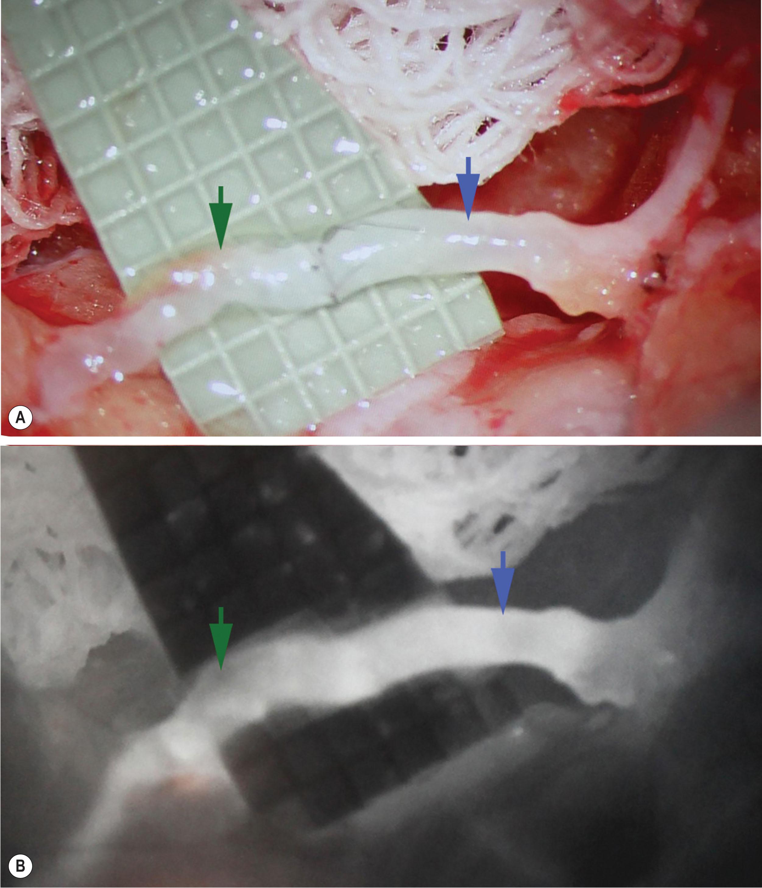 Figure 3.2.8, (A) LVA under microscope. (B) Microscope-integrated NIRF imaging confirms the patency of the anastomosis. (Blue arrow indicates the vein, green arrow indicates the lymph vessel.)