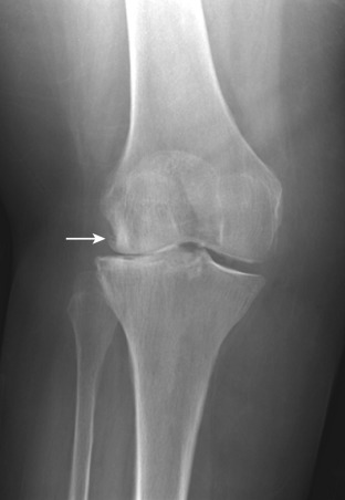 Figure 49-1, OA of knee joint on frontal radiograph. Note characteristic osteophyte formation ( arrow ), subchondral sclerosis, and joint space narrowing predominantly involving lateral compartment.