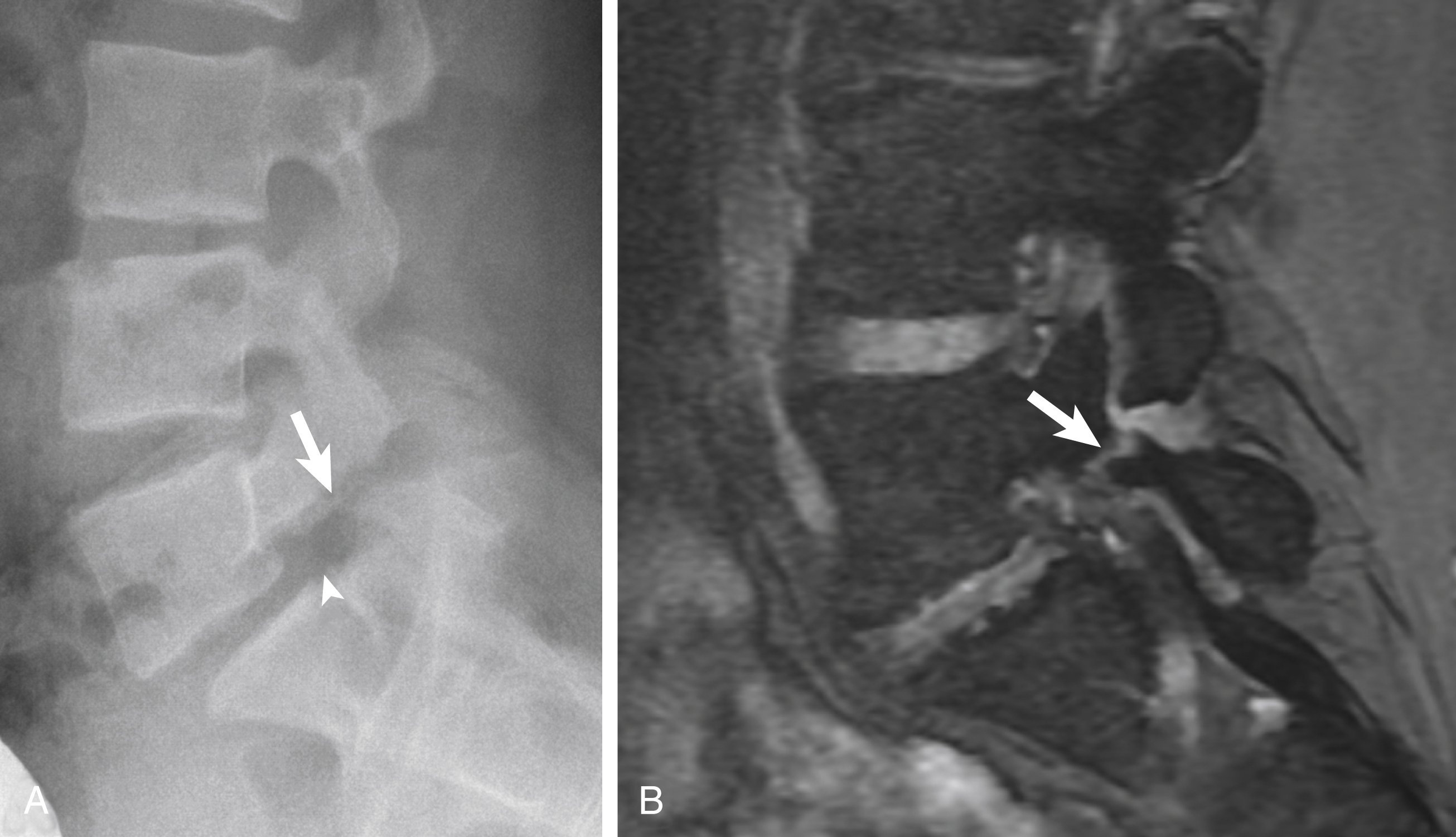 Fig. 30.1, (A) Lateral radiograph of the lumbosacral junction shows a diastatic L5 pars fracture ( arrow ) and grade 1 spondylolisthesis of L5 on S1 ( arrowhead ). (B) Sagittal gradient-echo magnetic resonance image shows a mildly diastatic chronic fracture ( arrow ).